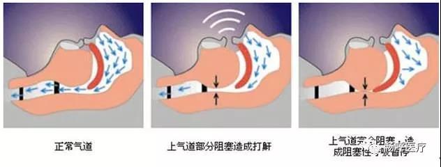 我國3000萬高血壓患者都有這毛?。∧阒绬?？